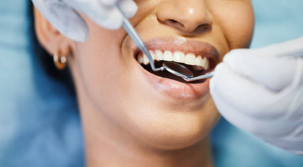 Best Emergency Dentist for Lost Fillings or Crowns in Dellwood, MO